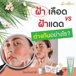❌ฝ้าเลือดคืออะไร? รักษาฝ้าชนิดนี้ได้อย่างไร?